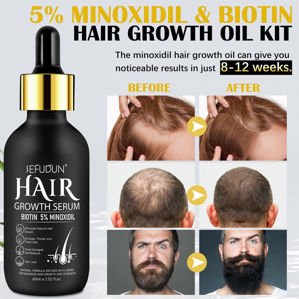 SEFUDUN Minoxidil Hair Growth Essence Kosteuttaa hiuspohjaa ja ehkäisee hiustenlähtöä microne Rollerilla hinta ja tiedot | Intiimipesutuotteet | hobbyhall.fi