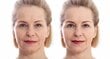Neulaton mesoterapialaite kasvojen puhdistukseen Beautifly B-Glossy Pro hinta ja tiedot | Kasvojenhoitolaitteet | hobbyhall.fi