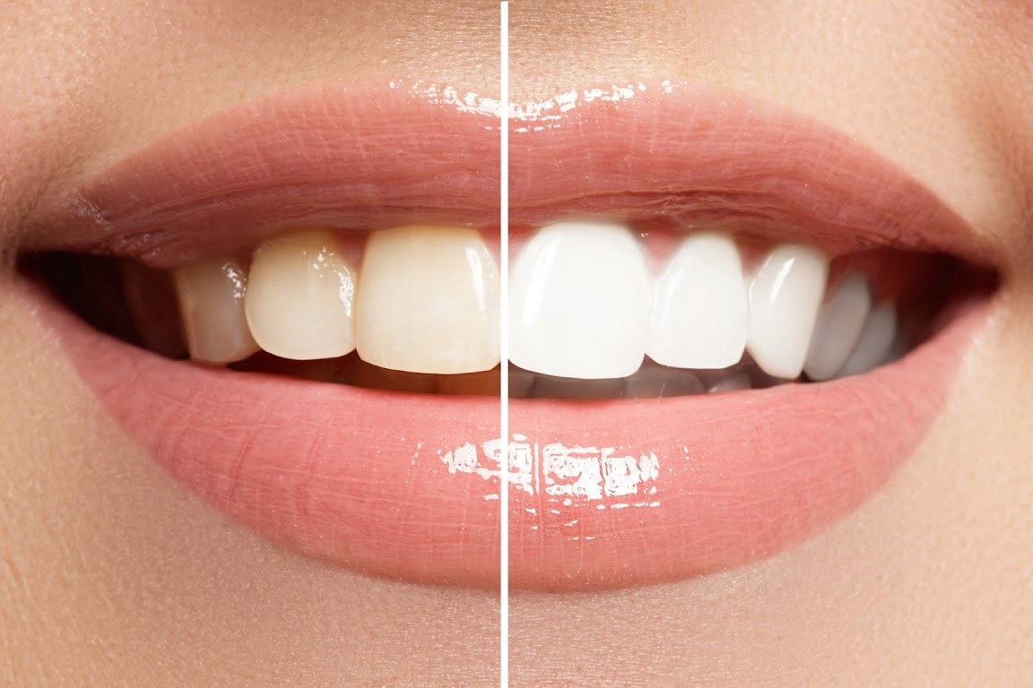 Hampaiden valkaisusarja LED IVISMILE +free Packaging Status alkuperäinen